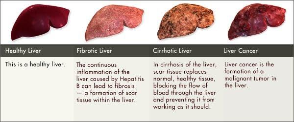 liver-type